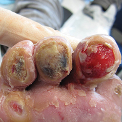 Diabetic foot ulcer