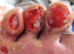 Diabetic foot ulcer two